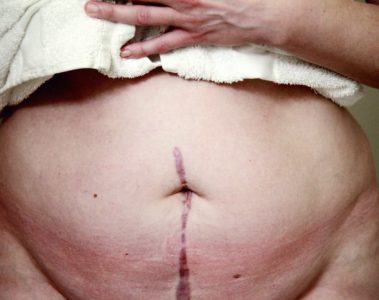 Comment perdre du ventre après une hystérectomie