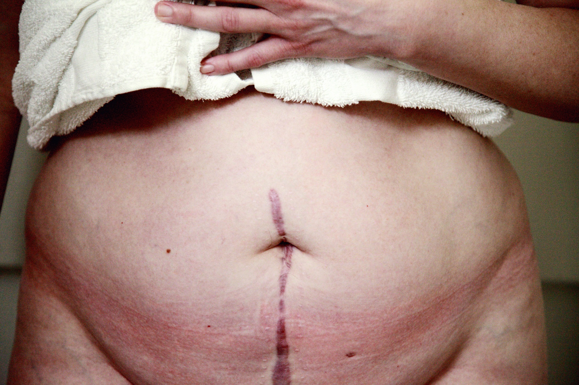 Comment perdre du ventre après une hystérectomie en 2022