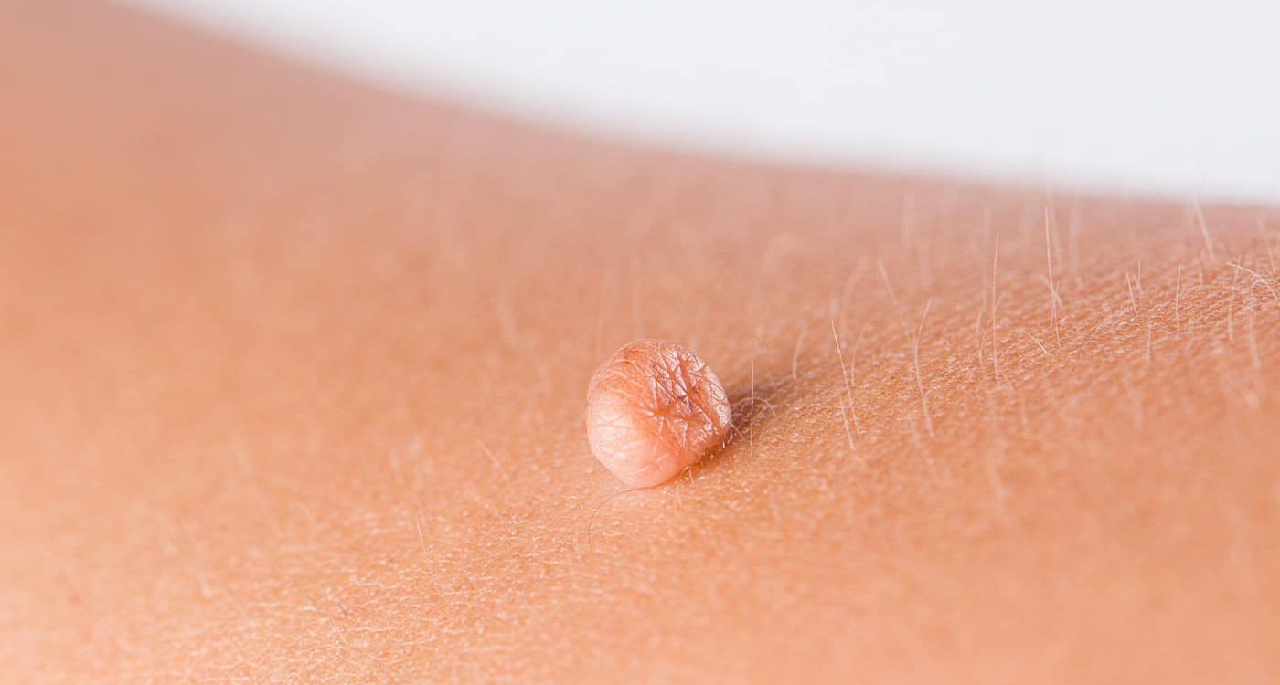 Enlever les acrochordons et grains de beauté indésirables : une spécialité de la dermatologie au laser