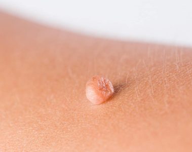 Enlever les acrochordons et grains de beauté indésirables : une spécialité de la dermatologie au laser