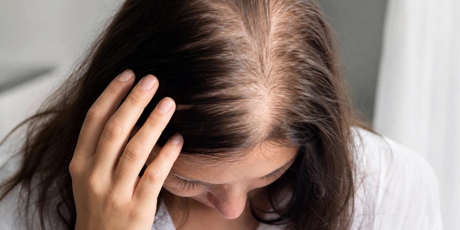 Femme écartant ses cheveux pour montrer une raie plus visible sur le sommet du crâne
